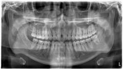 Tonsilolith in Routine Panoramic Radiographies